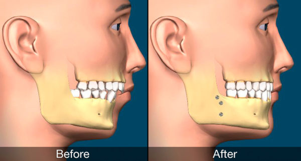 virtual model of a patient's teeth before and after surgical orthodontics